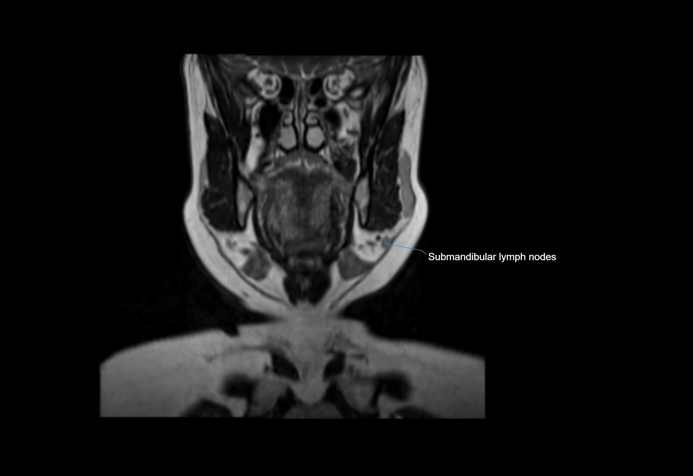 Neck coronal lymph node cross sectional MRI anatomy 3T MRI  image-img-00001-00052.webp